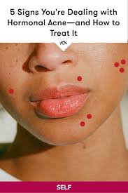 We normally associate acne with being a teenager, but research shows that over 50% of people in their twenties and 25% of people in their. Pin On Health Wellness