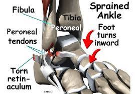 The lateral retinaculum is a ligament that helps hold your patella, or kneecap, in place. Peroneal Tendon Subluxation Orthogate