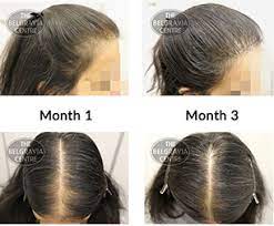It is directed on increasing blood flow to the scalp and stimulating new hair to grow. Confusion Over Seborrhoeic Dermatitis And Seborrhoeic Alopecia