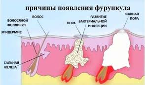 как вылечить горло за один день в домашних условиях Prichiny I Lechenie Furunkuleza V Domashnih Usloviyah Kak Izbavitsya Ot Furunkulov Navsegda Domashnee Lechenie Chistoe Lico I Zdorove