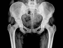 It may be worse at night or when the bone is used, for instance, leg pain when walking. Understanding Spinal Osteosarcomas