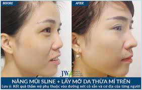 Kéo dài mũi ngắn hếch với chuyên gia hàng đầu Hàn Quốc