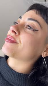 👃💋 Rinolips, Dr. Agustín Cáceres, Intervenimos el perfil nasal y labial  en una única sesión, sin cirugía., El objetivo fue elevar la punta,  suavizar el dorso y perfilar el labio inferior con mínima ...