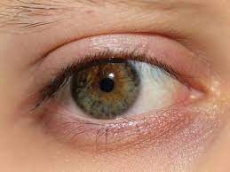 Hysterectomy Hormones And Dry Eyes Hormones Matter