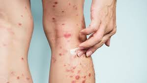 Image result for psoriasis