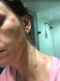 Bed bug bites can be painful and can even cause serious health concerns. Picture In The Bathroom Of The Bed Bug Bites On My Neck And Face Springhill Suites Miami Downtown Medical Center Tripadvisor