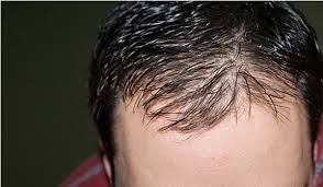 Her scalp still looks full and she's still very pleased with her density and nobody (even her) knows there is any. Baldness Causes And Treatment