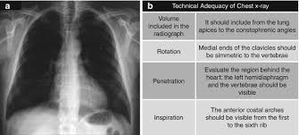 Image result for Chest XRay Interpretation