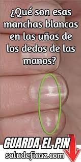 Porque Salen Manchas Blancas En Las Unas Delas Manos Unas Con Manchas Blancas Las Unas Manchas