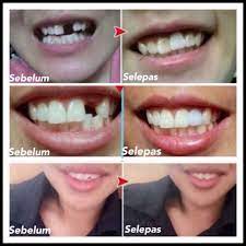 Tanpa adanya gigi, makanan tidak akan terkunyah. Gigi Palsu Original Solid Dentures Boleh Kunyah Makanan Tak Mudah Cabut Shopee Malaysia