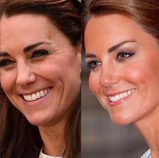 Kate Middleton se ha sometido a cirugía estética? ¿Está permitido en la  familia real?