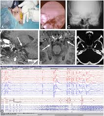 Frontiers | Neuroanatomical and psychological considerations in temporal  lobe epilepsy