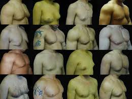 If an operation is carried out any earlier, any breast tissue that is left may simply regrow following the procedure, leading to a poor outcome. How To Lose Man Boobs Get Rid Of Gynecomastia Moobs Gyno Exercise