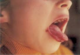 Disqueratose congénita, uma doença enigmática