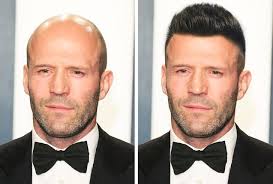 The hair loss became so bad that she wore wigs for five years until her hair grew back after she became pregnant. We Imagined 15 Bald Celebs With A Full Head Of Hair And They Look Irresistible