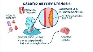Image result for carotid artery
