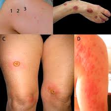 Official website · non toxic · brand new · safe ingredients Clinical Manifestations Of Bed Bug Bites Three Or Four Skin Lesions Download Scientific Diagram