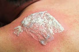 Tattoo removal in denver, co start your journey today removery is the largest specialized provider of laser tattoo removal in the world. Colorado Springs Tattoo Removal Tattoo Removal Colorado Springs
