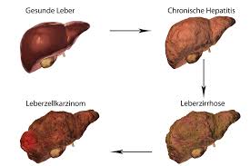 It's commonly caused by a viral infection, but there are other possible causes of hepatitis. Hepatitis