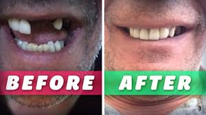 Instructions on how to make false teeth. Denturas Uk Diy Denture Kit Make Your Own Artificial False Teeth