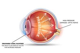 If you have glaucoma, regular checkups and following your treatment plan can help slow or prevent vision problems. Glaucoma Glaucoma Treatment