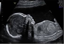 Monash Ultrasound Treatments And Services Monash Ultrasound