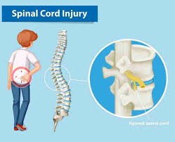 Image result for Spinal Trauma