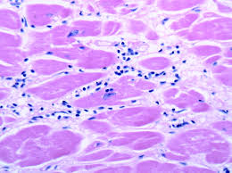 Clinical presentation clinical presentation is variable in severity, ranging from asymptomatic to. Myocarditis Circulation