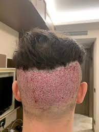 Brit 26 Left With Horrific Scars After Botched 1 250 Hair Transplant In Turkey