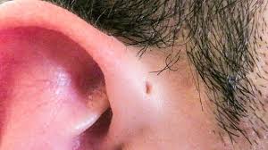 I need something much bigger. Hole In Ear Symptoms Causes And Treatment Of Preauricular Pits