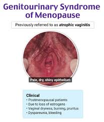 Image result for Atrophic Vaginitis