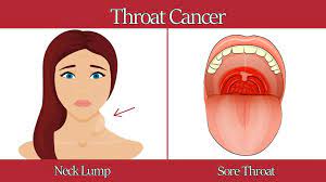 Throat cancer and tongue cancer can be very dangerous types of cancer as they can block the ability to breathe and/or eat. 6 Warning Signs Of Throat Cancer Womenworking