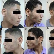 A 20-year man, right side: combined treatment side, a; before...