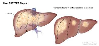 Childhood Liver Cancer Treatment Pdq