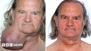 Melon-size tumour removed from Scunthorpe man's neck after 24 years
