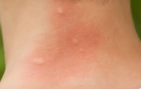 Czy wiesz jakie skutki przynosi zarażenie bakterią borrelia burgdorferi? Ukaszenia Komarow Kleszczy Pszczol Domowe Sposoby Leczenia Babli Lista Natemat Pl