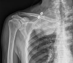 Image result for Shoulder XRay