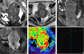 Computerized tomography scan or ct scan is another method to determine whether the woman is suffering from endometriosis or not. Dynamic Contrast Enhanced Mr And Pet Ct Findings Of Uterine Sarcomatoid Carcinoma A Case Report Bmc Women S Health Full Text