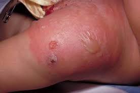 Solitamente questi sintomi appaiono nell'area vicino a un taglio o una piaga. Cellulite Patologie Della Cute Manuale Msd Versione Per I Pazienti