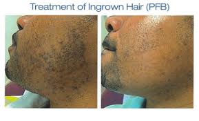 Ingrown hairs initially appear around the time of puberty when the hormonal fluctuations starts and they might also appear later in life normally due to hormonal changes. Razor Bumps Ingrown Hair In Brooklyn Ny Dr Ghatan Dermatology Cosmetic Laser Surgery