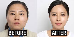 Why Korean Parents Are Having Their Kids Get Plastic Surgery Before College Best Plastic Surgeons Korean Plastic Surgery Plastic Surgery Korea