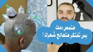علاج تساقط الشعر والصلع الوراثي الحجامة لتساقط الشعر Youtube