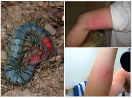 Tambahnya, mayat mangsa kemudian diserahkan kepada. Gigit Scolopendra Foto Pertolongan Cemas Untuk Gigitan Scolopendra