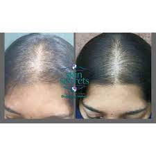 Skin Secrets Kochi Best Skin Clinic In Cochin Skin Clinic In Kochiskin Secret Near Me Skin Clinic Hair Loss Treatments Good Skin