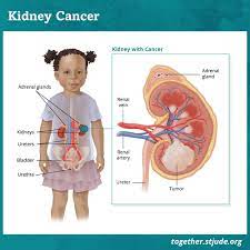 Weight loss with no known cause. Kidney Tumors In Children And Teens Together