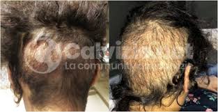 Trapianto di capelli a torino: Trapianti Capelli Low Cost Pro E Contro Calvizie Net