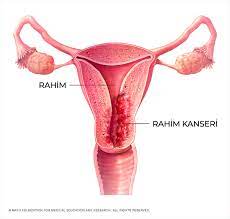 Kanserin yayılıp yayılmadığını tanılamak ve evreleme yapmak için kullanılır. Rahim Kanseri Nedir Neden Olur Belirtileri Nelerdir