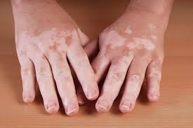 Image result for Vitiligo