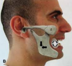 Image result for Jaw Dislocation