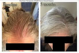 Studies show that both men and women report hair loss as one of the side effects they fear most after being diagnosed with cancer. Permanent Chemotherapy Induced Alopecia Reversal Follicle Thought